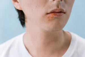 Närbild på en mun med munsår, associerat med stress och obehag under löpning.